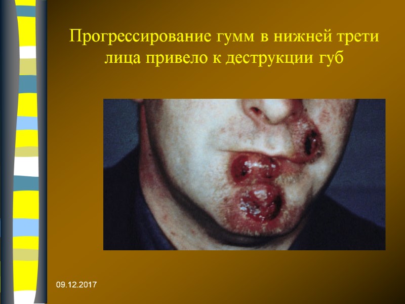 Прогрессирование гумм в нижней трети лица привело к деструкции губ  09.12.2017